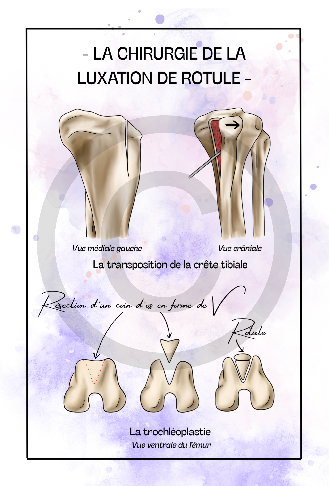 La luxation de rotule - Chirurgie