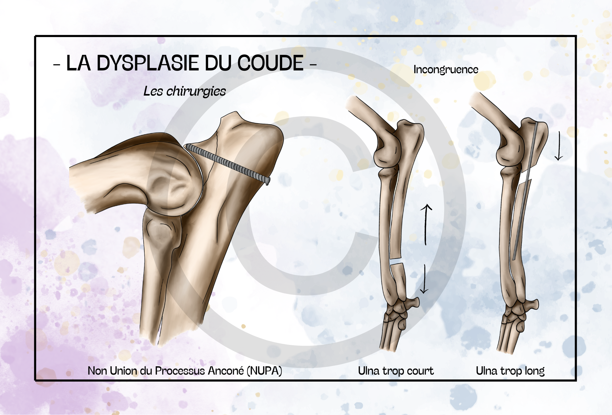 La dysplasie du coude - Les chirurgies