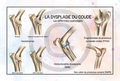 La dysplasie du coude - Les différentes pathologies