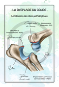La dysplasie du coude - Localisation des sites pathologiques
