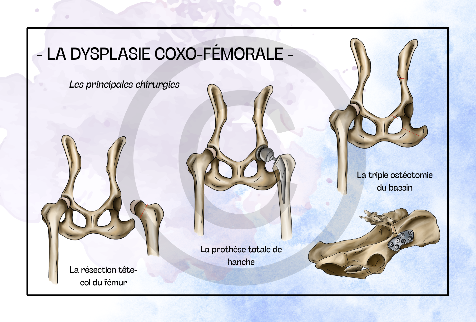La dysplasie coxo-fémorale - Les principales chirurgies