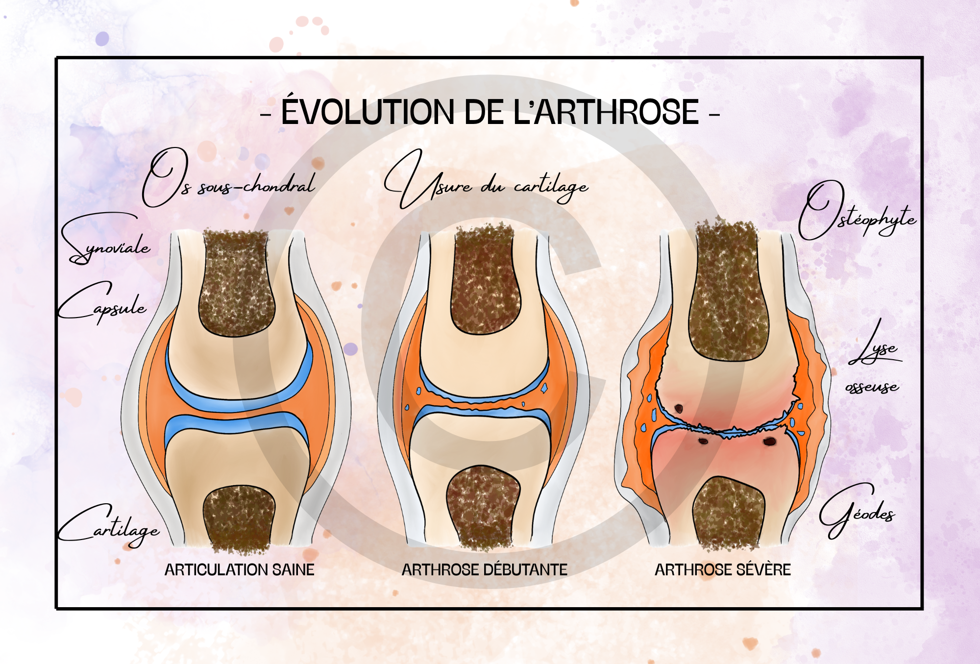 L'évolution de l'arthrose