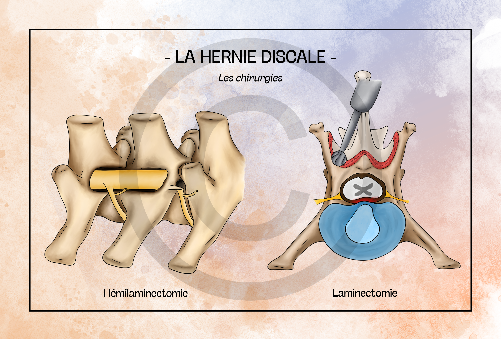 Pack Hernie discale - 5 planches