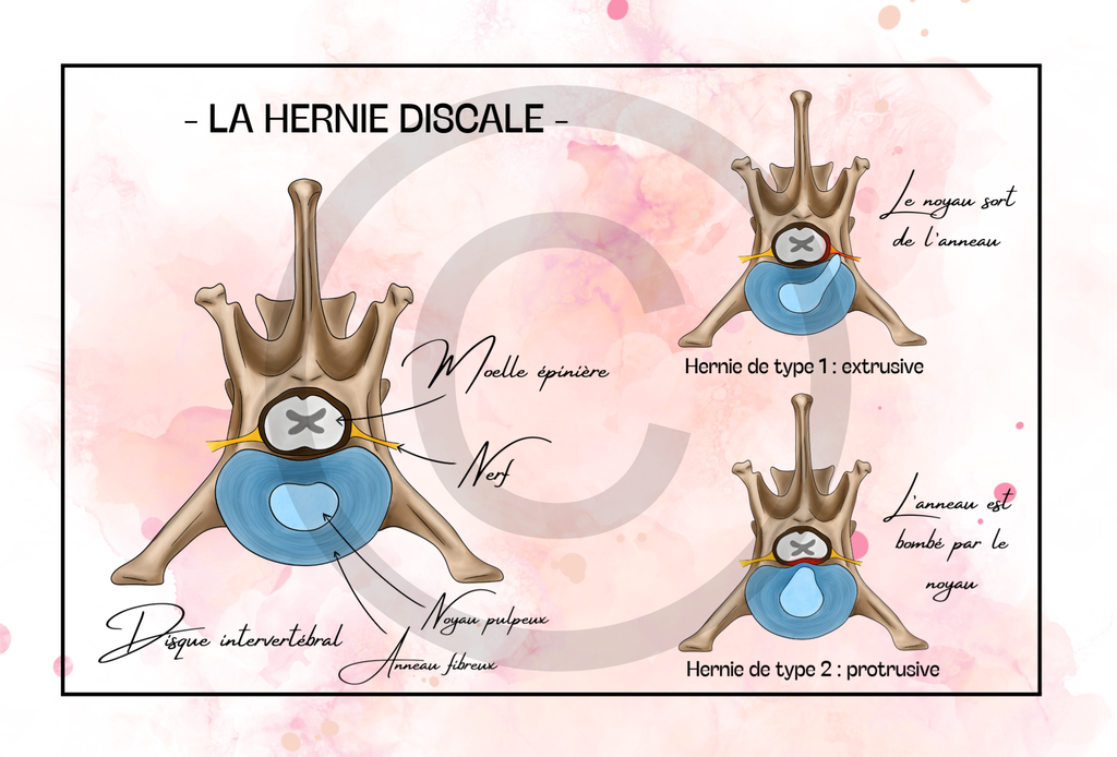 Pack Hernie discale - 5 planches