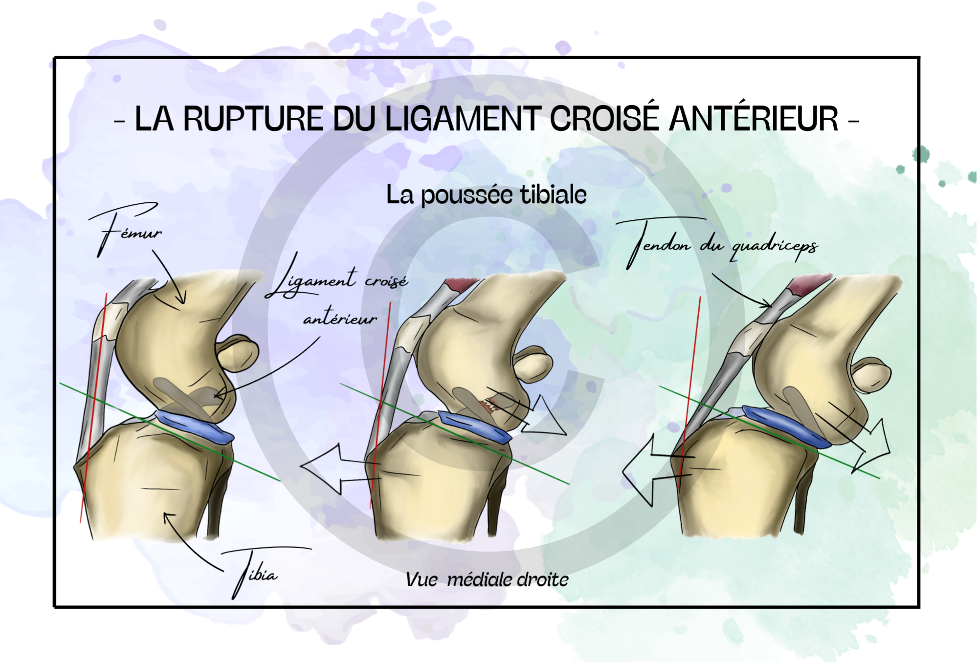 RLCA - La poussée tibiale