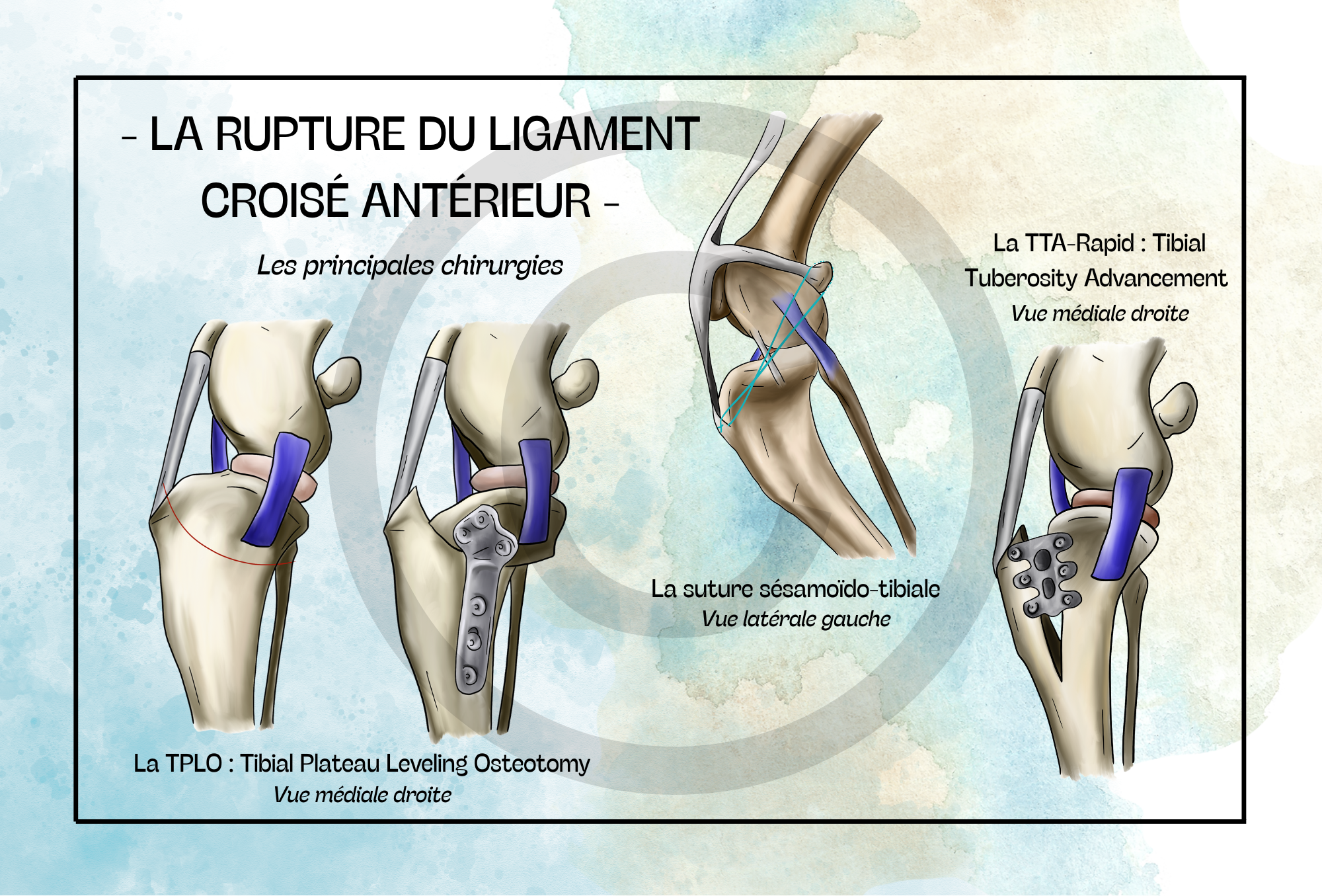 RLCA - Les principales chirurgies